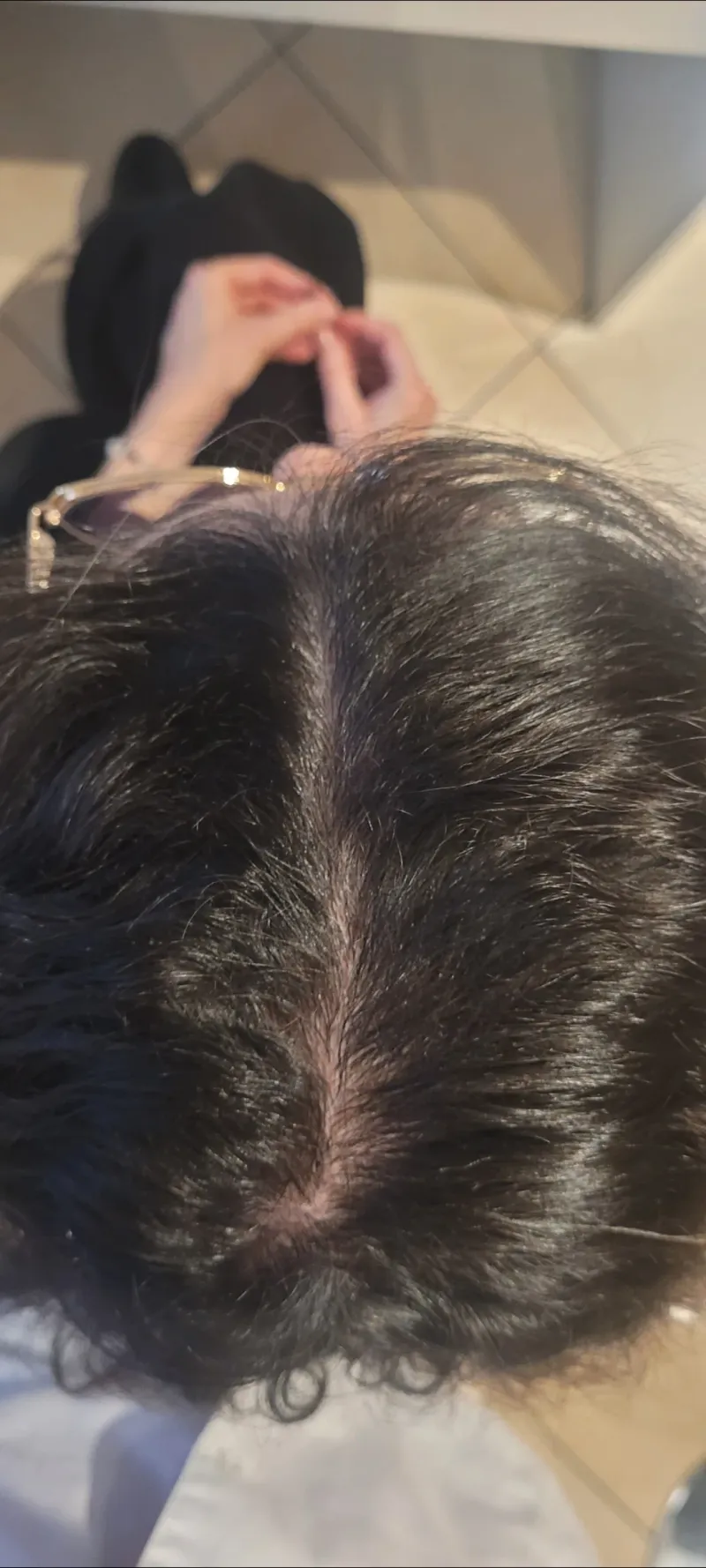 Łysienie androgenowe żeńskie (FPHL) — widok skóry głowy w trakcie terapii, mniejsze przerzedzenie