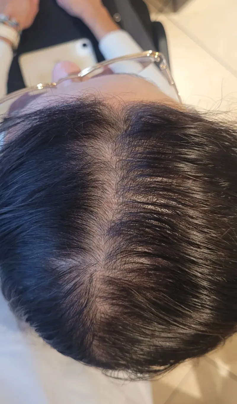 Łysienie androgenowe żeńskie (FPHL) — widok skóry głowy przed terapią, widoczne poszerzenie przedziałku