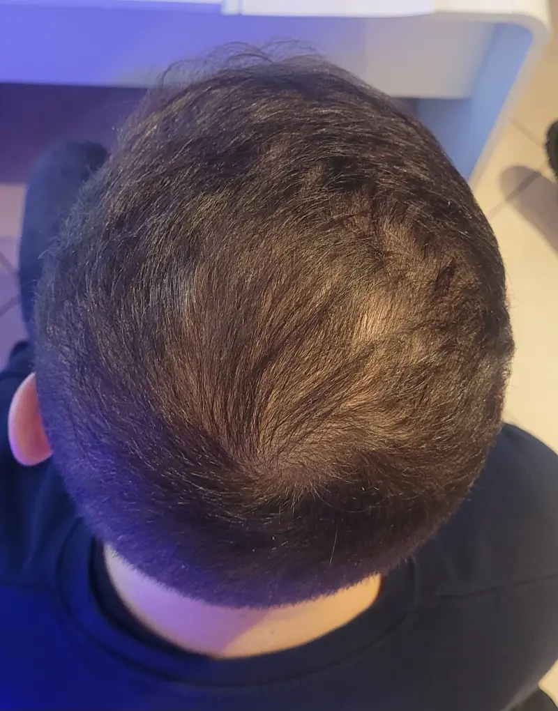 Łysienie androgenowe, przypadek 2 — po terapii, poprawa gęstości