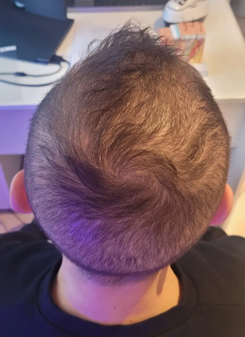 Łysienie androgenowe, przypadek 2 — widok skóry głowy przed terapią