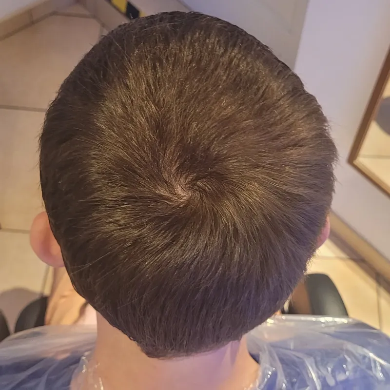 Łysienie androgenowe, przypadek 3 — po terapii, widoczna poprawa