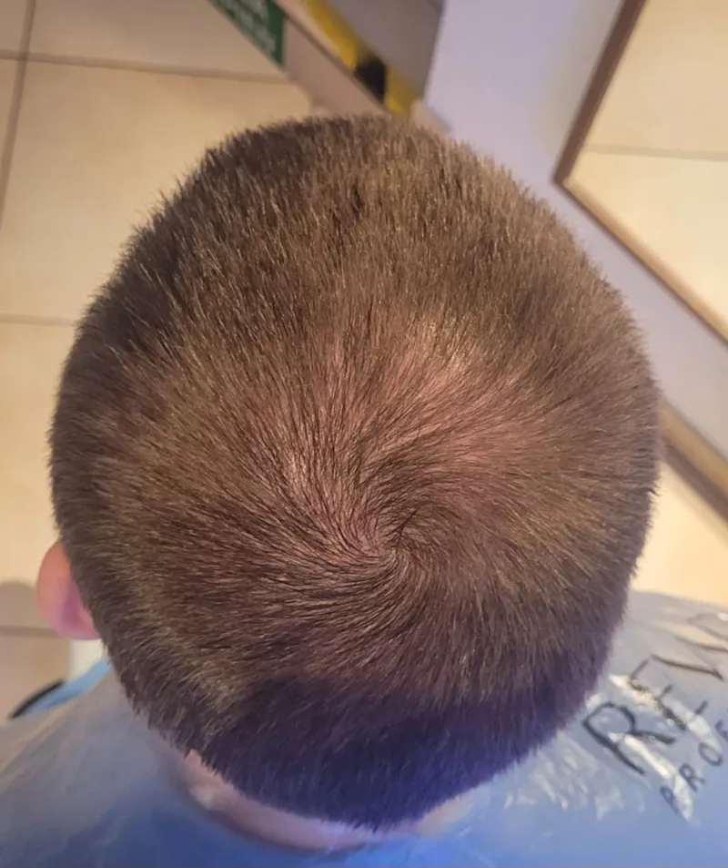 Łysienie androgenowe, przypadek 3 — widok skóry głowy przed terapią