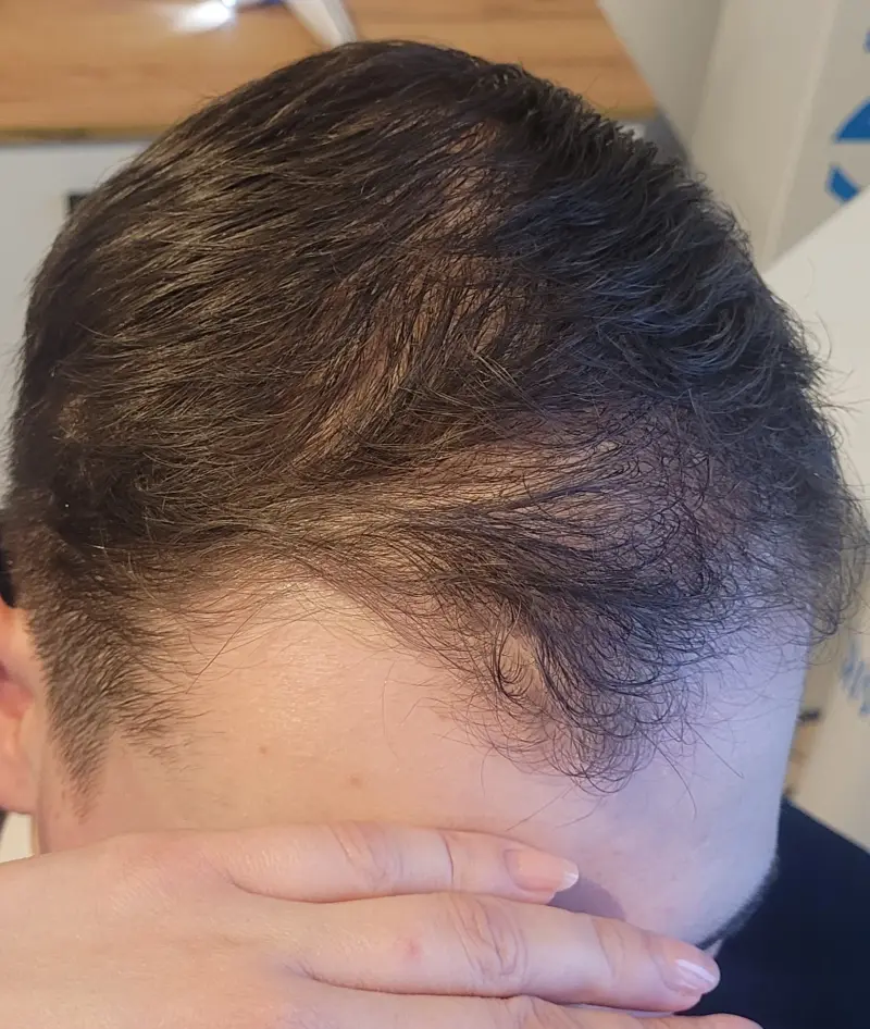 Łysienie androgenowe, przypadek 4 — po terapii, widoczna poprawa gęstości włosów