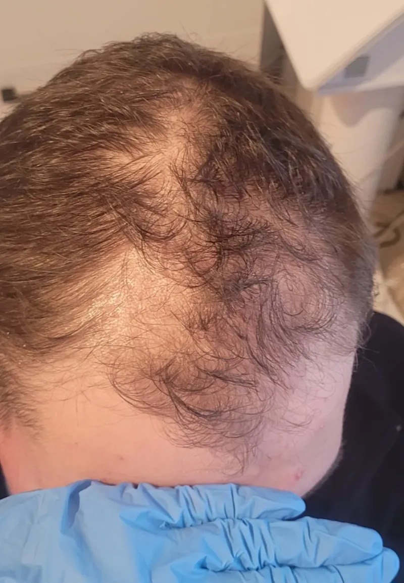 Łysienie androgenowe, przypadek 4 — widok skóry głowy przed terapią