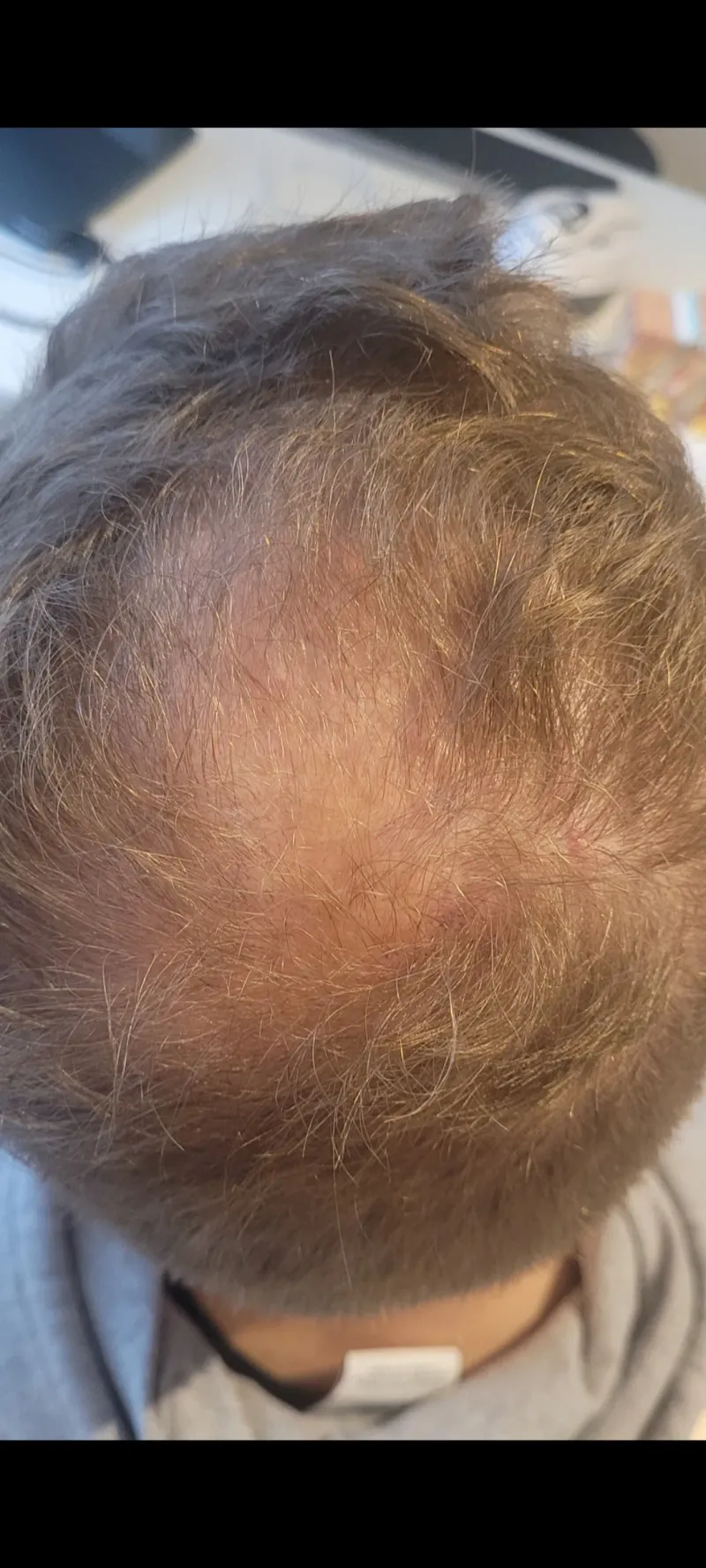 Łysienie androgenowe, przypadek 1 — skóra głowy przed terapią