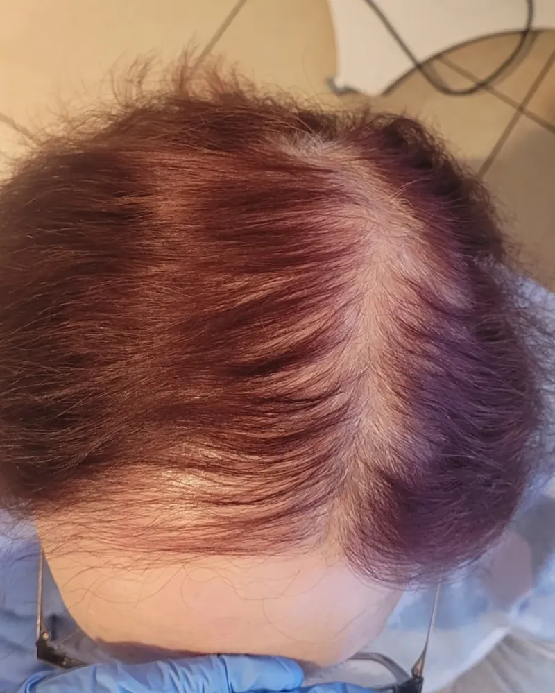 Łysienie bliznowaciejące — widok skóry głowy w trakcie terapii, poprawa gęstości włosów