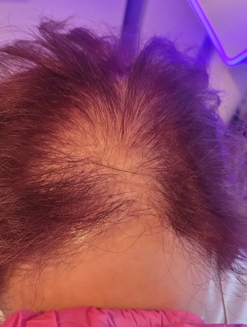 Łysienie bliznowaciejące — widok skóry głowy przed rozpoczęciem terapii, widoczne przerzedzenia