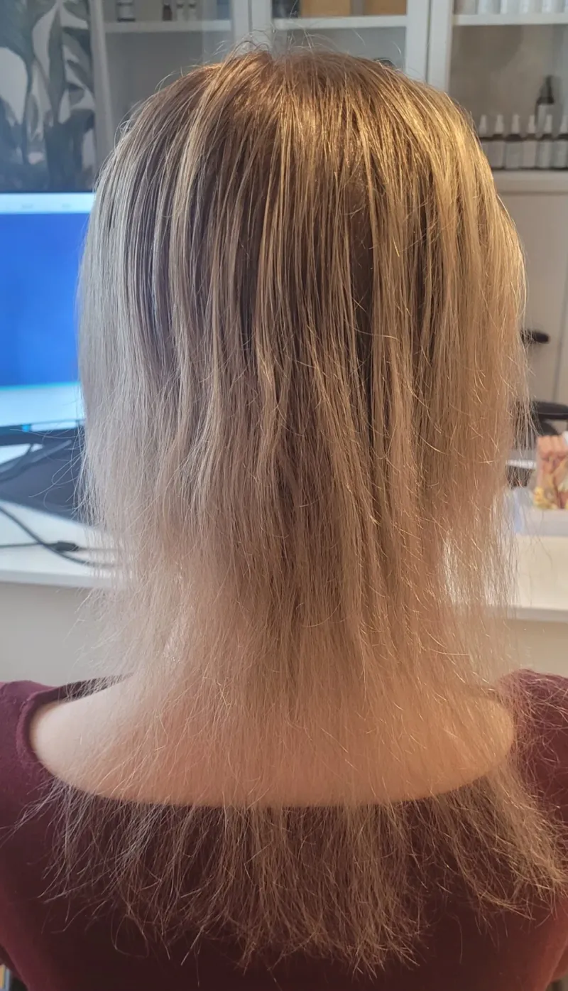 Skrócony anagen — włosy przed terapią, widoczne przerzedzenie i skrócona faza wzrostu