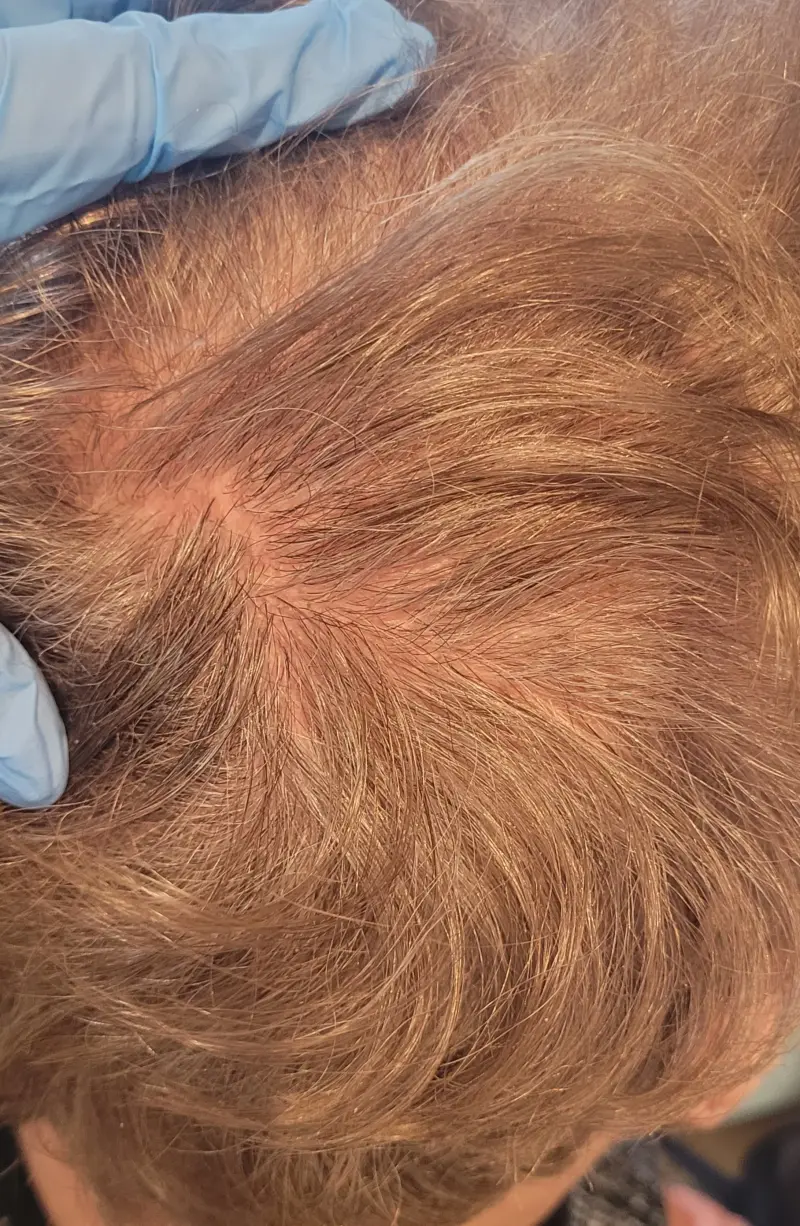 Trichotillomania — odrost włosów w miejscu ubytku w trakcie terapii