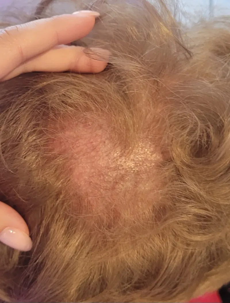 Trichotillomania — widoczny ubytek włosów na skórze głowy przed terapią