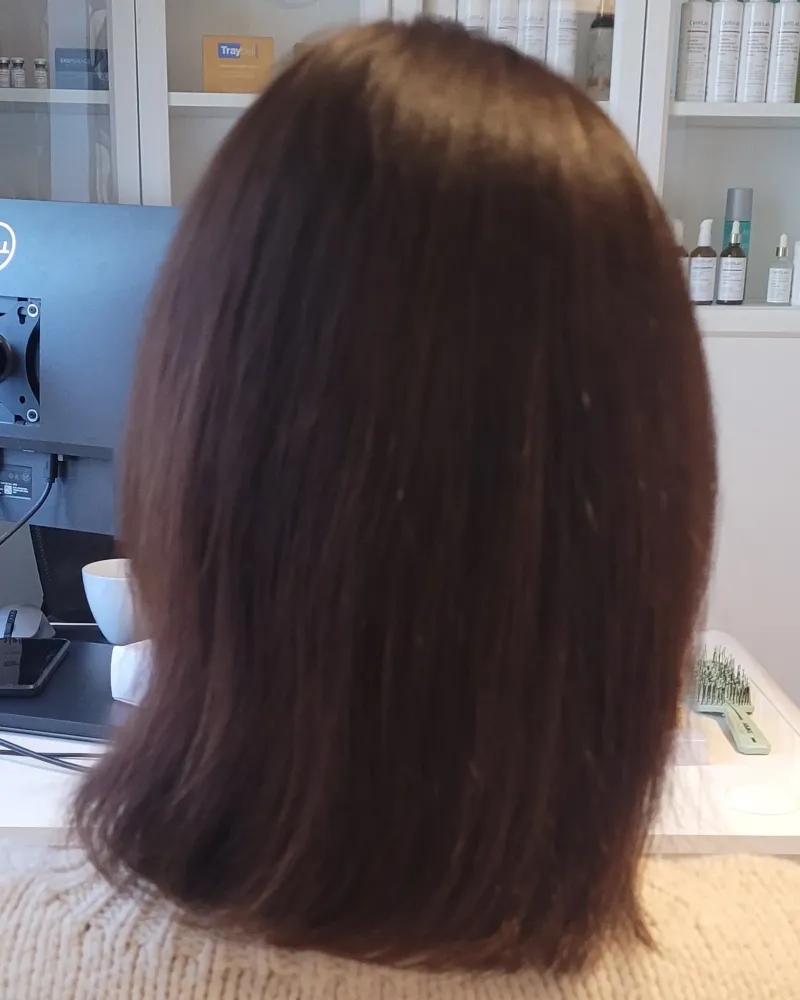 Łysienie telogenowe — poprawa gęstości i kondycji włosów po terapii