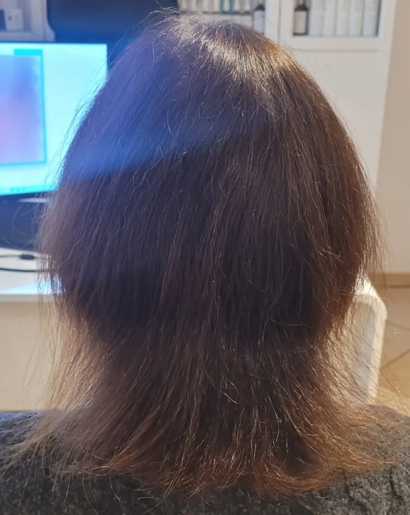 Łysienie telogenowe — włosy przed terapią, widoczne przerzedzenie i wykruszanie