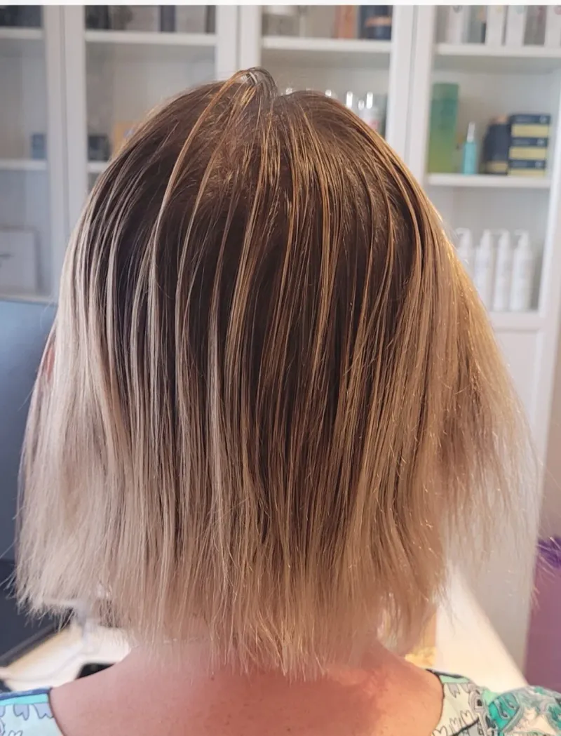 Łysienie telogenowe — widoczne przerzedzenie włosów przed rozpoczęciem terapii