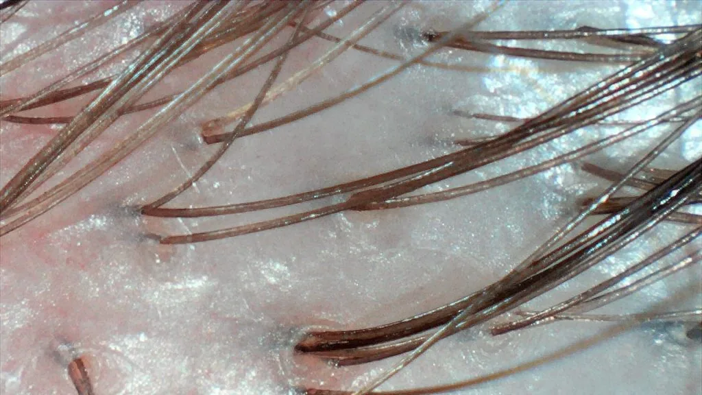 Skóra głowy po zabiegu oczyszczającym — czysta, odświeżona skóra