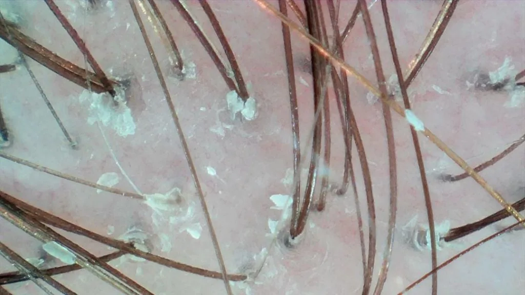 Skóra głowy przed zabiegiem oczyszczającym — widoczne złogi i stan zapalny